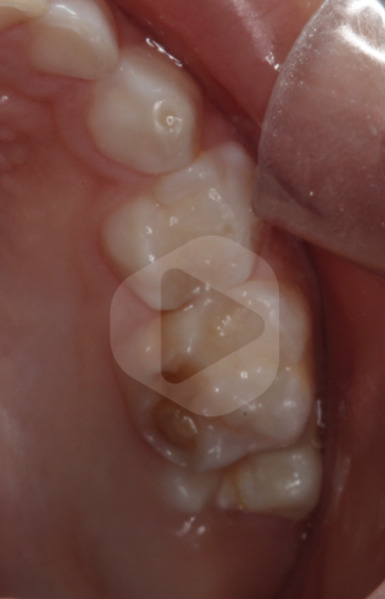 Imagem clinica da impacção do primeiro molar permanente
